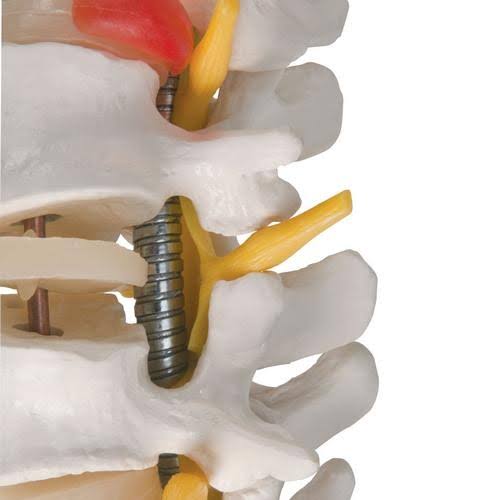 Highly Flexible Spine Model F787